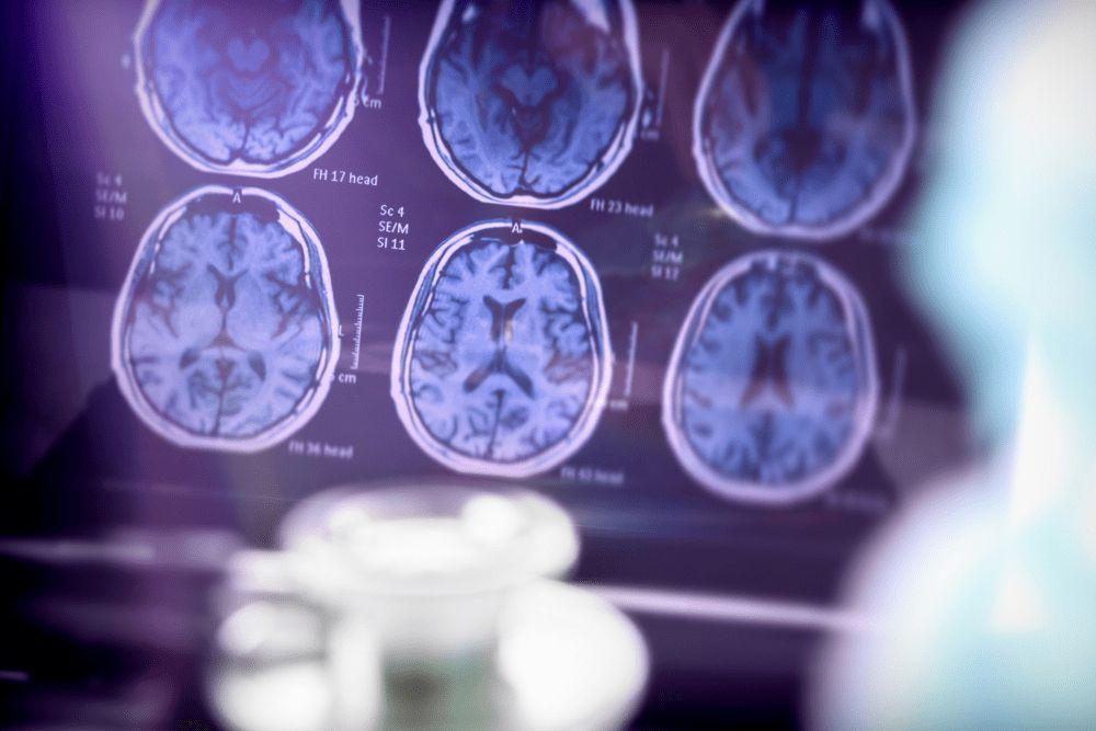cerebro adicto