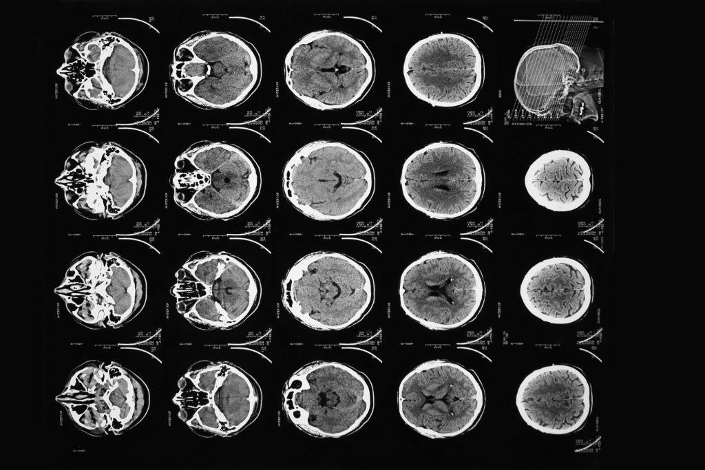 C&oacute;mo el cerebro se recupera de las drogas